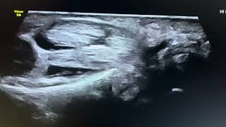 Ultrasound of tenosynovitis [upl. by Fen]