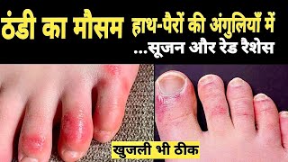 ठंड से हाथ पैरों की उंगलियों मे सूजन रेड रैशेस व खुजली का उपाय Remedies for Chilblains amp itching [upl. by Virgilio]