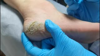 Callus removal from feetampFoot scraping dead skin [upl. by Victorine]