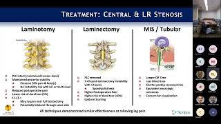 Neurogenic Claudication amp Lateral Recess Stenosis  Rick Lang MD on August 15 2022 [upl. by Nagaet]