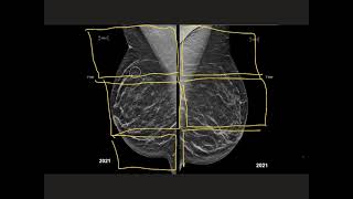 Mammography Positioning Guide Video  Sino MedicalDevice Technology [upl. by Eizus]