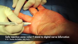 Live Surgery Digital Block Anesthesia of the Finger [upl. by Hite220]