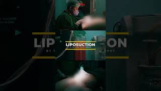 Liposuction for weight loss  fyp liposuction lipo beforeandafter [upl. by Hope]