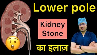 Lower Pole में Kidney Stones कैसे निकालें  Kidney Stones In Lower Pole How do we remove it rirs [upl. by Trefler]