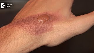 How to treat a burn blister at home Tips to avoid burn scar  Dr Pavan Murdeshwar [upl. by Simara959]