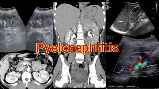 Radiology Viva Case  05  Pyelonephritis Complicated by Pseudoaneurysm medical radiology doppler [upl. by Llerrem123]