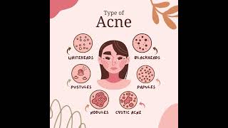 Type Of Acne [upl. by Sophie]