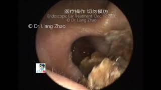 Endoscopic clearance of middle ear cholesteatoma cavity 12 min [upl. by Jacobba626]