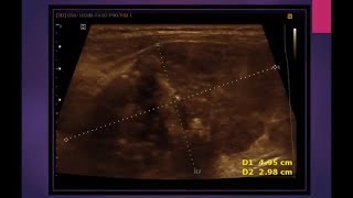 MEDULLARY THYROID CARCINOMA [upl. by Ahtiekahs718]