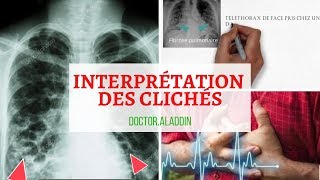 Pneumopathie Interstitielle Diffuse  Maitriser linterprétation des clichés [upl. by Ed]