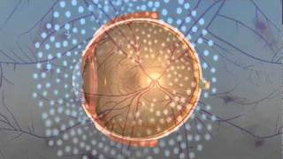 Vitrectomy Surgery for Diabetic Retinopathy [upl. by Corabella]