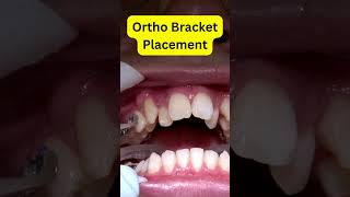 Braces Installation REVEALED Step by Step [upl. by Wardlaw865]