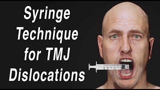 Syringe Method to SelfReduce TMJ Jaw Dislocation Open Lockjaw [upl. by Ispep]