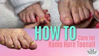 How to Pedicure Nail Care on Rams Horn Toenail [upl. by Sidonius]