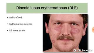 Discoid Lupus Erythematosus DLE [upl. by Redla]