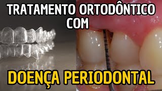 Tratamento ortodôntico de pacientes com doença periodontal  Parte 1 Aula 235 [upl. by Oneal170]