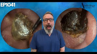 The Most Shocking Ear Wax Removal Youve Never Seen  EP1041 [upl. by Bevis]