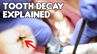 Tooth Decay Cavity Explained  Cavities vs Fillings vs Dental Caries [upl. by Ahsienad]