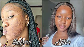 How I finally cleared my acne prone skin  Skin care routine🧴with photo evidence [upl. by Turtle]