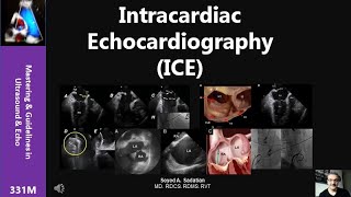 Intracardiac Echocardiography ICE [upl. by Fran]