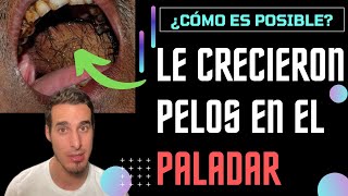 Le crecen PELOS en el paladar boca y lengua  ¿Cómo es posible [upl. by Atsirhc]