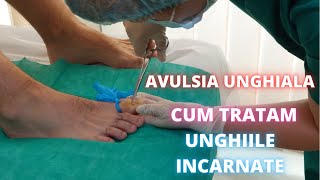 Avulsie Unghiala unghie incarnata  Testimonial pacient DermaBeauty Clinique [upl. by Ree]