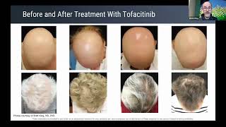 Alopecia areata treatment update and lessons learned from recent clinical trials [upl. by Dugan14]