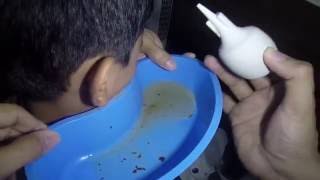 Ear Wax Removal Kit How to [upl. by Dimo182]