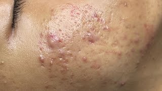 ACNE TREATMENT VU QUYNH MI  Perennial Blackheads On Boy Face 2024FULL [upl. by Ahteres]