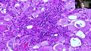 Tip39Ganglioglioma [upl. by Ontine691]