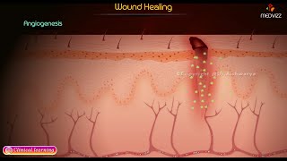 Wound Healing  Stages of healing and pathology [upl. by Nwahsauq634]