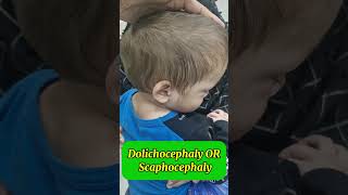 Dolichocephaly  Scaphocephaly Saggital craniosynostosis  abnormal head shape craniosynostosis [upl. by Allred]