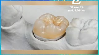 Incrustaciones de resina o porcelana en caries extensa [upl. by Ahsat]