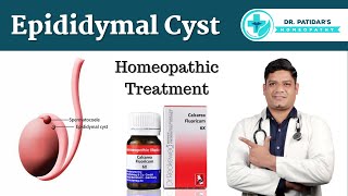 Epididymal Cyst Homeopathic Treatment amp Medicines  Dr Sunil Patidar [upl. by Darla374]