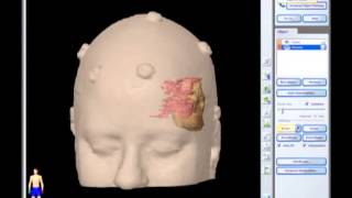 Removal of Brain Tumor Meningioma brain surgery [upl. by Milman]