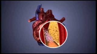 Atherosclerosis  3D Animation  ABP © [upl. by Theurer736]