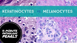 Melanocytes vs Keratinocytes Made Easy 5Minute Pathology Pearls [upl. by Aramad]