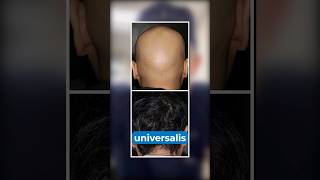 Cure for Complete Baldness [upl. by Ingmar]