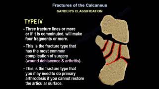 Fractures of the Calcaneus  Everything You Need To Know  Dr Nabil Ebraheim [upl. by Minetta]