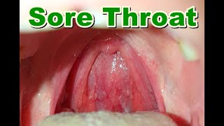 Normal vs Sore Throat  Pharyngitis [upl. by Elleuqram78]