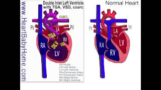 42 Double Inlet Left Ventricle with TGA vsd coarc [upl. by Atinat412]