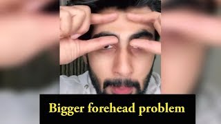 Mridul madhok Bigger forehead problem [upl. by Brunelle]