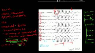 Pathophysiology of Seizures [upl. by Tonjes84]