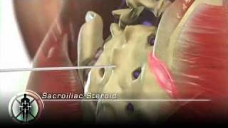 Sacroilliac Joint Steroid Injection [upl. by Kremer]