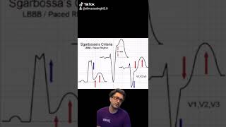 sgarbossa criteria made easy [upl. by Anibur]