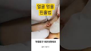 얼굴 멍울 수술 핀홀법 피지낭종 표피낭종 피부과 성형외과 병원 epidermal epidermoid cyst surgery seoul korea아문TV [upl. by Shae]