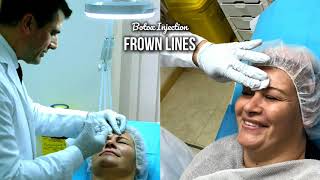 Anti wrinkles injection in Frown Lines  with Dr Allen Rezai [upl. by Rasecoiluj937]