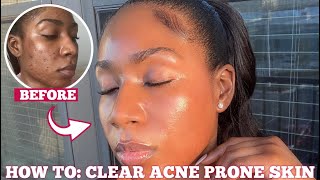 HOW I CLEARED MY ACNE SCARS amp HYPERPIGMENTATION FOR GOOD IN ONE MONTH  3 STEPS FOR FLAWLESS SKIN [upl. by Marleah]