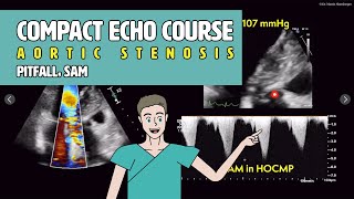 〖Echocardiography〗 LVOT obstruction amp SAM  pitfalls in aortic stenosis 🚨 [upl. by Sayer153]