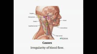 pulsatile tinnitus treatment [upl. by Llenna]